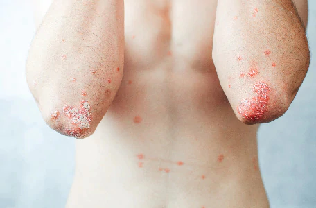 Photo psoriasis coudes